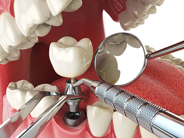 Best Emergency Wisdom Teeth Removal in Gaylord, MI